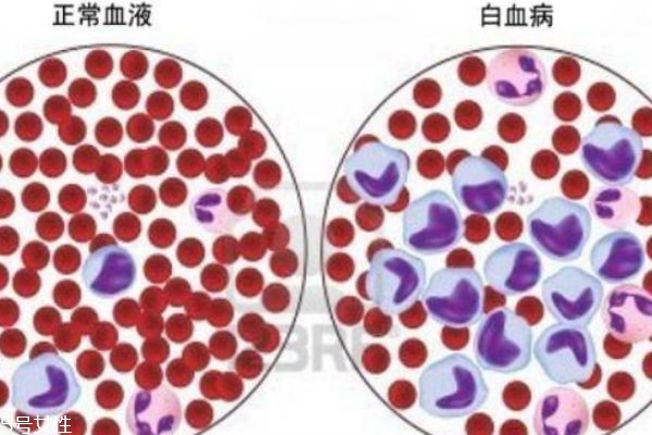 什么是白血病?白血病是如何引起的?,白血症可以治愈吗