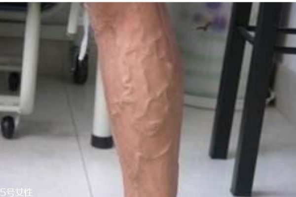 什么是静脉曲张,静脉曲张是怎么引起的