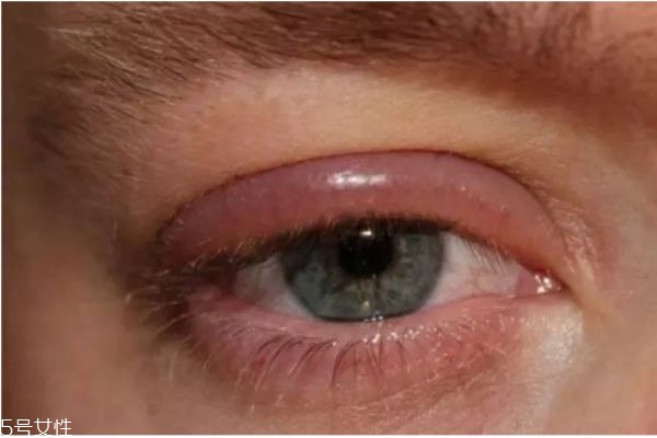 眼睛有刺疼感是怎么回事,眼睛总是胀痛怎么回事