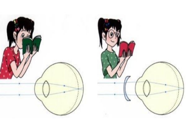 散光是怎么造成的可以矫正吗,眼睛散光是什么原因导致的 散光是怎么造成的可以矫正吗,眼睛散光是什么原因导致的