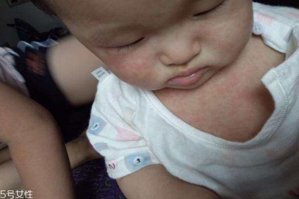 幼儿急疹和感冒发烧有什么区别,幼儿急疹和普通发烧的区别