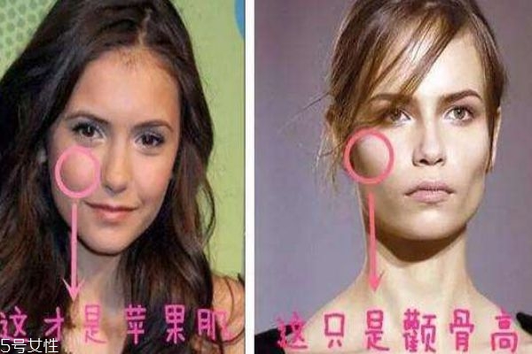 苹果肌和颧骨高区别,颧骨高苹果肌大怎么办