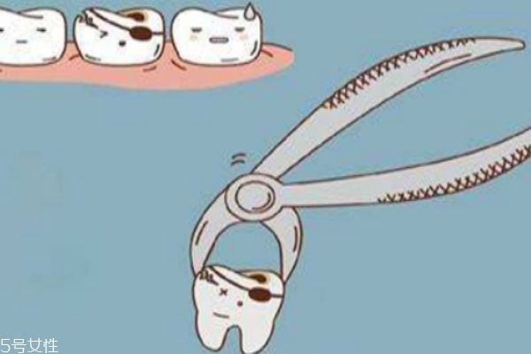 拔牙齿要多少天才能好,拔牙一般几天恢复正常