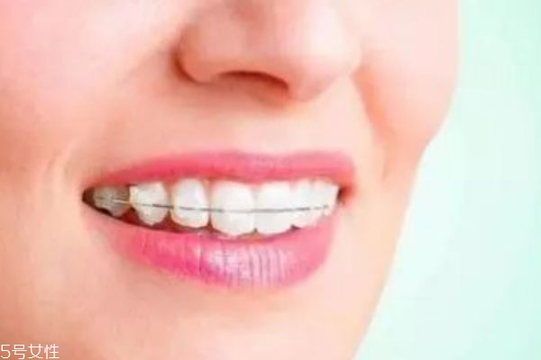 门牙稀缝隙大怎么办,大门牙上面有裂缝应该怎么办