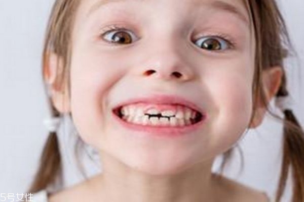 牙缝大怎么修复多少钱,牙缝大怎么修复最好 牙缝大怎么修复多少钱,牙缝大怎么修复最好