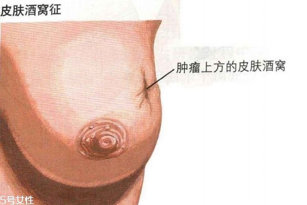 乳腺有哪些症状,乳腺增生的早期症状是哪些