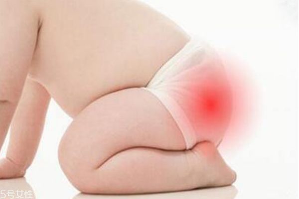 尿布疹用护臀膏有用吗,尿布疹可以用湿疹膏吗