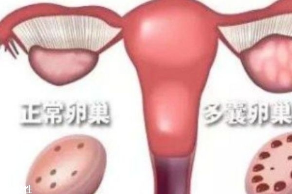 多囊卵巢综合症是什么意思,女人多囊卵巢是什么原因引起的