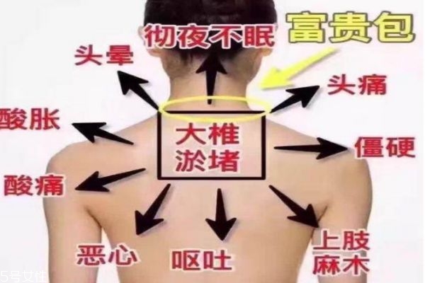 富贵包是什么病症,富贵包会引起什么病变呢