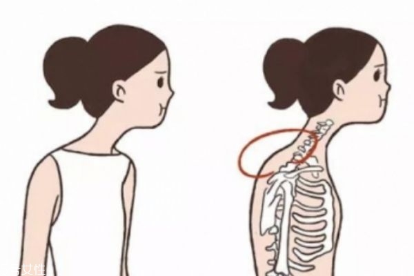 富贵包的危害有哪些?怎么形成的呢?,富贵包严重有什么后果