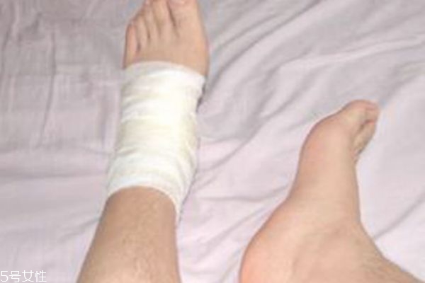 怎么判断扭伤骨头没事,如何判断扭伤是否伤到骨头