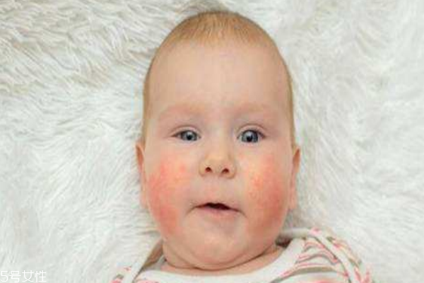 宝宝湿疹是怎么引起的?,婴儿的湿疹是怎么引起的?怎么办?