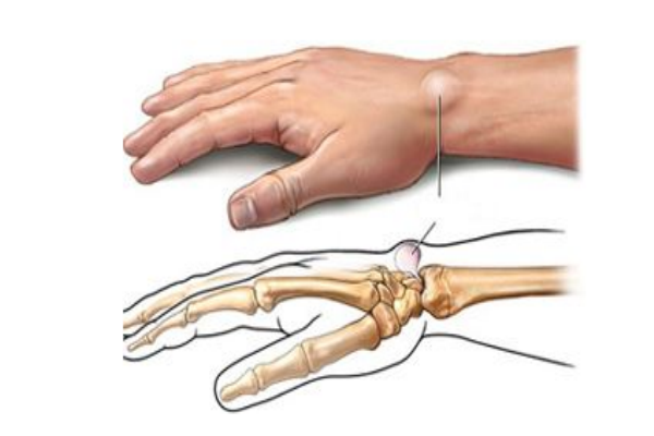 腱鞘炎是怎么引起的,怎么治疗最好,腱鞘炎是怎么引起的