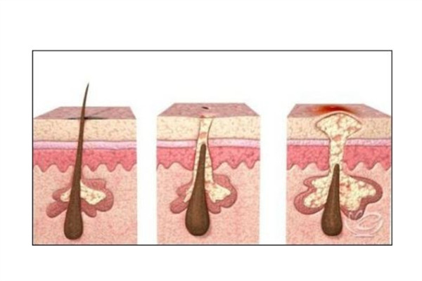 白头发怎么造成的,头发怎么会白