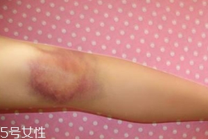 身体淤青怎么来的,身体怎么会出现淤青 身体淤青怎么来的,身体怎么会出现淤青