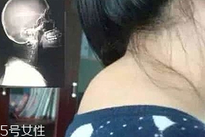 富贵包是病吗严重吗,脖子长富贵包是什么病