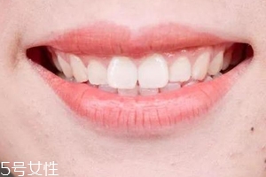 口红病是什么样的症状,口红病是什么