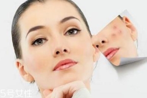 痘印多久能自己消失,痘印需要多久自行恢复