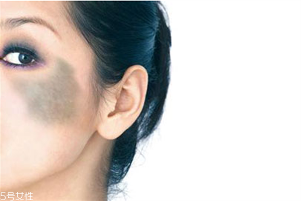 有胎记怎么去掉,胎记怎么去除最安全 有胎记怎么去掉,胎记怎么去除最安全