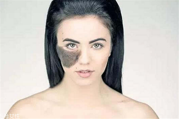 胎记长哪有福气,胎记长在哪里有福气 胎记长哪有福气,胎记长在哪里有福气