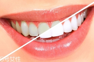 天生牙齿黄是什么原因,天生的牙齿黄该怎么办 天生牙齿黄是什么原因,天生的牙齿黄该怎么办