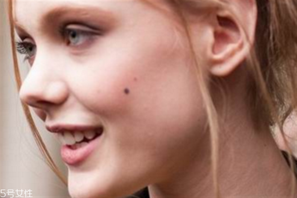 什么时候点痣最好 点痣的最佳时间,点痣什么时候去点最好