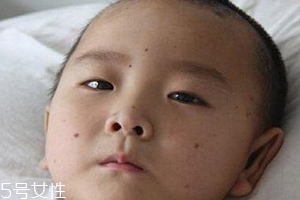 痣会变成肿瘤吗,痣在什么情况下会癌变