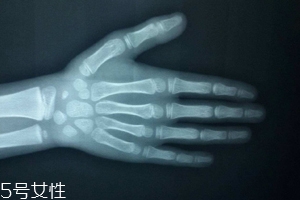 哪些人需要测骨龄,什么情况需要测骨龄 哪些人需要测骨龄,什么情况需要测骨龄