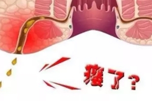 肛瘘只能手术治疗吗,治疗肛瘘不手术有什么最新方法