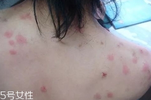 螨虫的危害有哪些?,螨虫对人体的危害有哪些