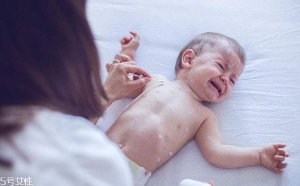 水痘什么传播途径,水痘通过啥传播