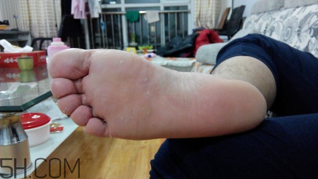 患上脚气的原因,得脚气病的原因