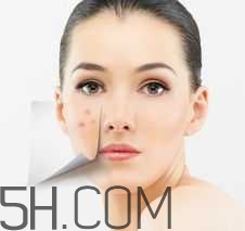 痤疮是湿热还是湿寒,湿热型痤疮怎么治疗