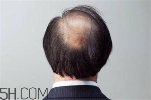 男人秃顶是什么原因造成的,现在很多男的都秃顶是什么原因