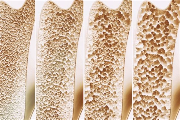 骨质疏松吃什么好得快,吃什么东西补骨质疏松