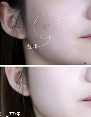 用酒精消毒可以治疗脸上长痘痘吗(脸上长痘能用酒精消毒吗)