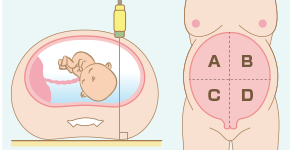 怎么检验羊水太多或太少(怎样知道羊水多还是少) 怎么检验羊水太多或太少(怎样知道羊水多还是少)