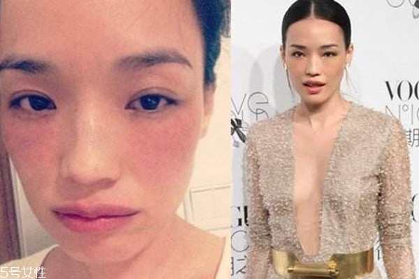 脸上长雀斑怎么根治,雀斑可以根治吗 脸上长雀斑怎么根治,雀斑可以根治吗