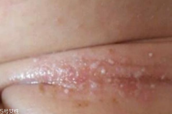 淹脖子可以用紫草油吗(宝宝淹脖子可以用紫草油吗)