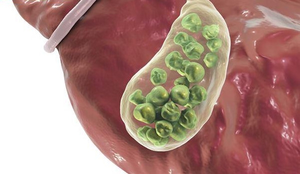 空腹胆汁淤积,查胆汁淤积综合症要空腹吗