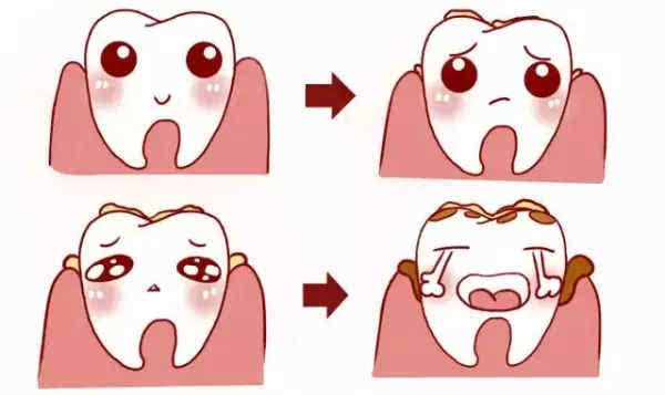 洗牙后要注意什么(洗牙之前需要注意什么) 洗牙后要注意什么(洗牙之前需要注意什么)