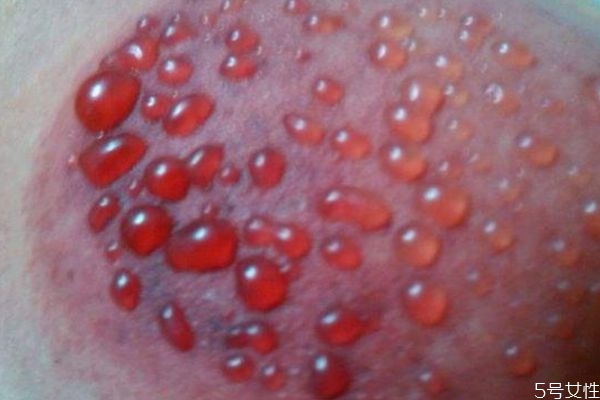 拔罐出水泡怎么回事(拔罐出水泡怎么回事怎么处理)