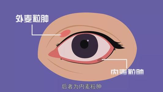 怎么防止麦粒肿交叉感染(麦粒肿感染了怎么办)