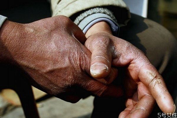 手脱皮应该怎么办呢(手脱皮应该怎么办呢)