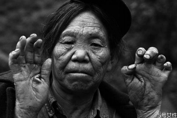 麻风病应该怎么预防呢(麻风病如何预防)