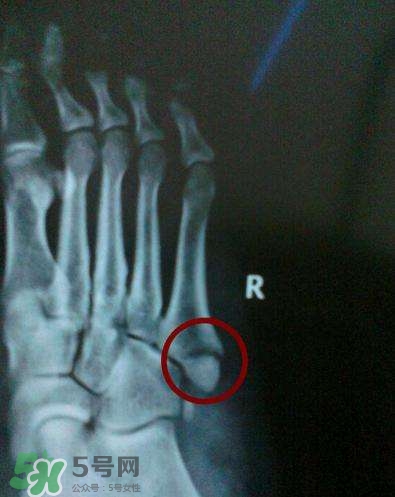 骨折或骨裂吃什么痊愈的比较快,骨裂吃啥好得快