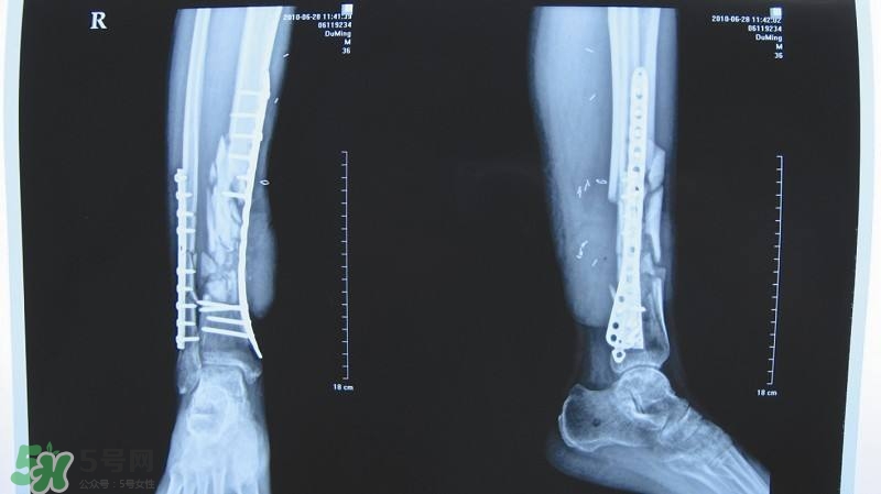 骨折后吃什么食物好得快,骨折了吃什么好的最快窍门 骨折后吃什么食物好得快,骨折了吃什么好的最快窍门