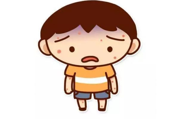 天花应该怎么治疗呢(天花如何治疗)