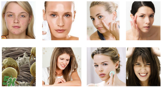 香皂能去黑头吗,用硫磺皂洗脸可以去黑头吗