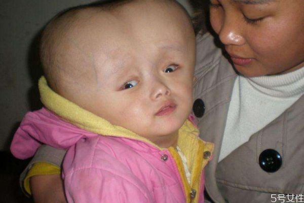 脑积水的症状有什么呢(脑积水的症状有哪些)